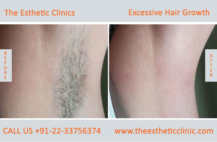 Excessive Hair Growth Removal Treatment before after photos in mumbai india (7)